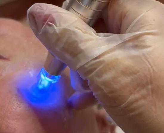 UTSUKUSY ENPITSU DERMA PEN PRO.7 MEZOTERAPIJOS PRIETAISAS