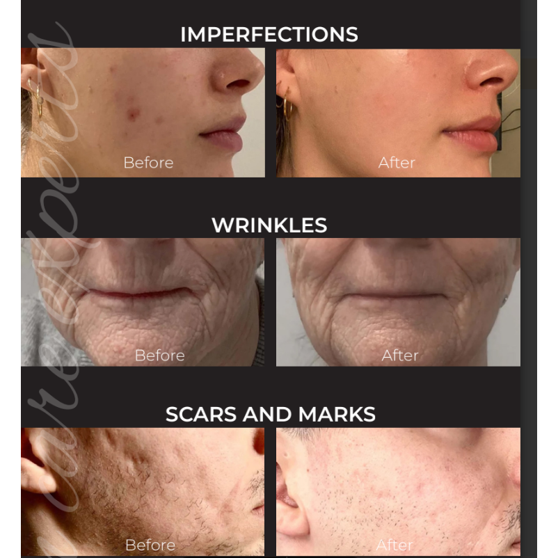 UTSUKUSY MESO SKIN DUAL KOSMETOLOGINIS PRIETAISAS