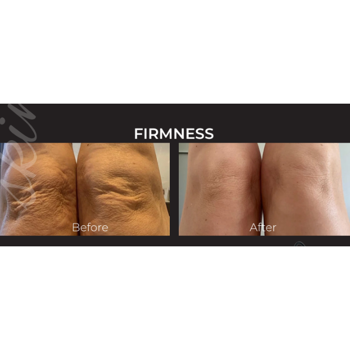 UTSUKUSY MESO SKIN DUAL KOSMETOLOGINIS PRIETAISAS